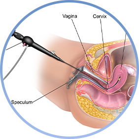 hysteroscopic myomectomy-1